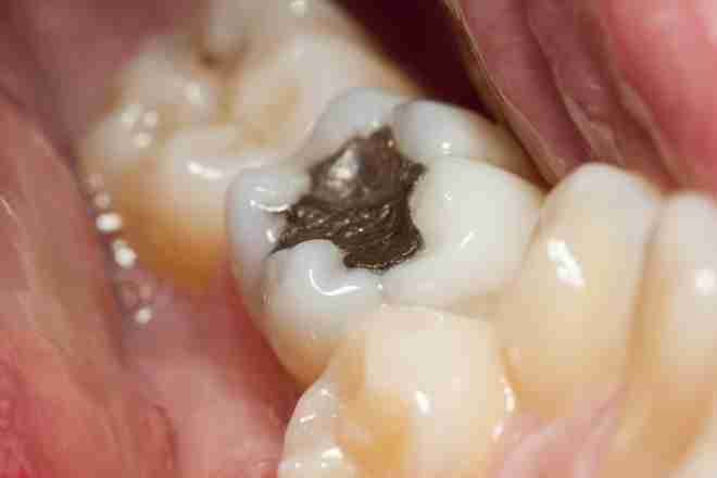 Amalgam